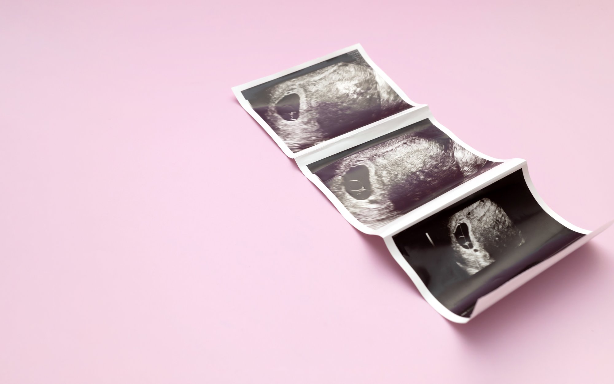 Selektywna aborcja: Kontrowersje wokół decyzji o redukcji ciąży bliźniaczej