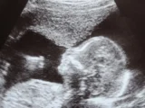 Sprawa dotycząca aborcji w Nowym Meksyku kończy się ugodą i rodzi nowe pytania prawne